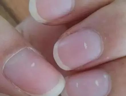 孩子指甲軟薄易斷、月牙少、長白點(diǎn)、豎紋是顯示身體有健康風(fēng)險(xiǎn)嗎？(圖6)