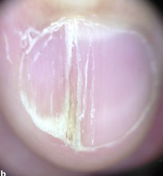 孩子指甲軟薄易斷、月牙少、長白點(diǎn)、豎紋是顯示身體有健康風(fēng)險(xiǎn)嗎？(圖11)