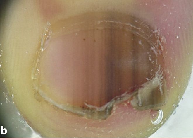 孩子指甲軟薄易斷、月牙少、長白點(diǎn)、豎紋是顯示身體有健康風(fēng)險(xiǎn)嗎？(圖8)