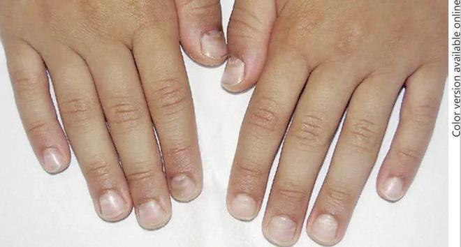 孩子指甲軟薄易斷、月牙少、長白點(diǎn)、豎紋是顯示身體有健康風(fēng)險(xiǎn)嗎？(圖10)