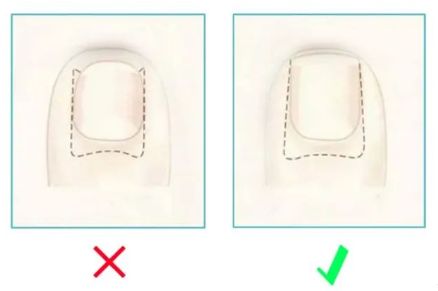孩子指甲軟薄易斷、月牙少、長白點(diǎn)、豎紋是顯示身體有健康風(fēng)險(xiǎn)嗎？(圖13)