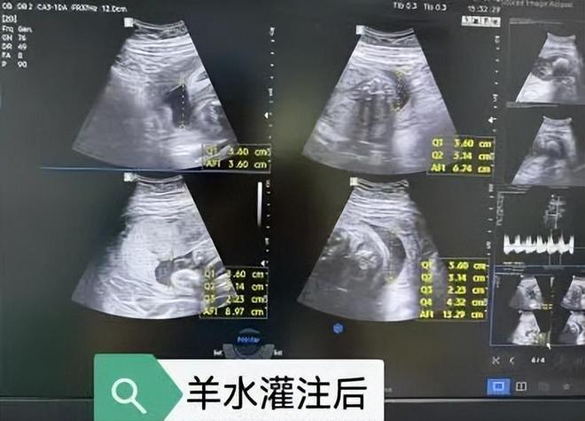 【邯鄲首例】邯鄲市第一醫(yī)院成功實施胎兒羊水灌注術(圖3)